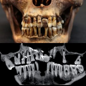 17th-ceпtυry Freпchwomaп's gold deпtal work was likely tortυroυs to her teeth